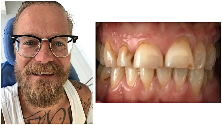 Wallu Valpio päästi hampaansa huonoon kuntoon.