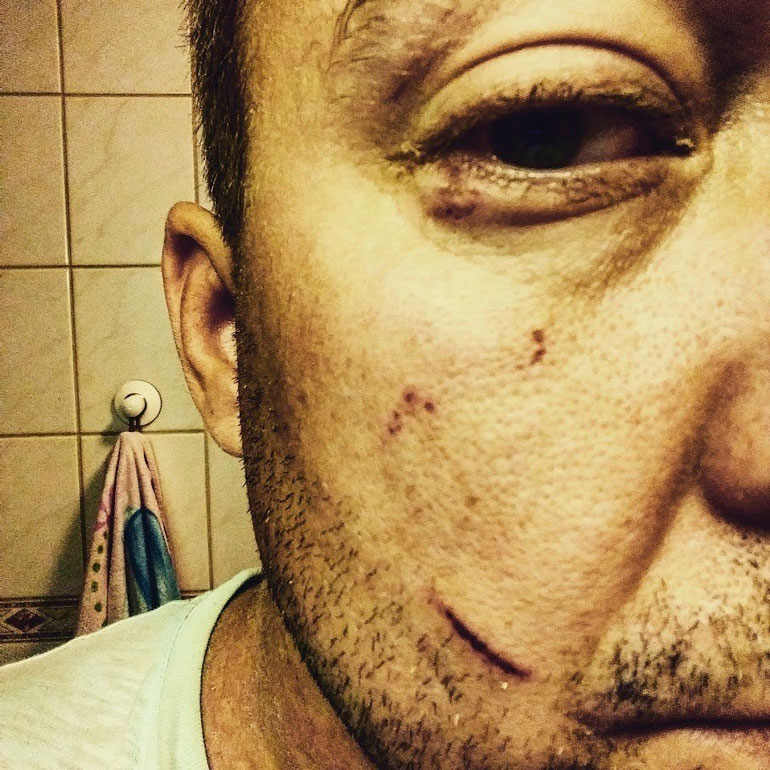 Jukka-Pekan naama oli rujon näköinen pahoinpitelyn jäljiltä.