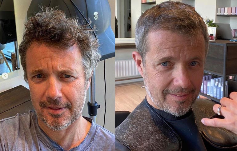 Prinssi Frederik ennen ja jälkeen hiusoperaation.