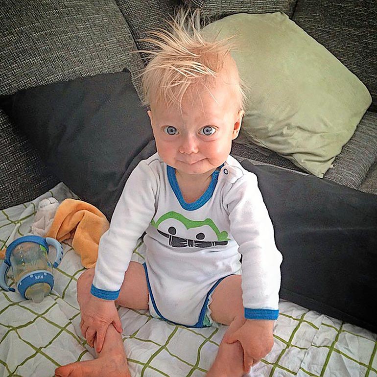 Lukella oli hiukset vielä kaksivuotiaana, mutta hän menetti ne, koska hänen ruumiinsa vanhenee ennätysnopeudella.