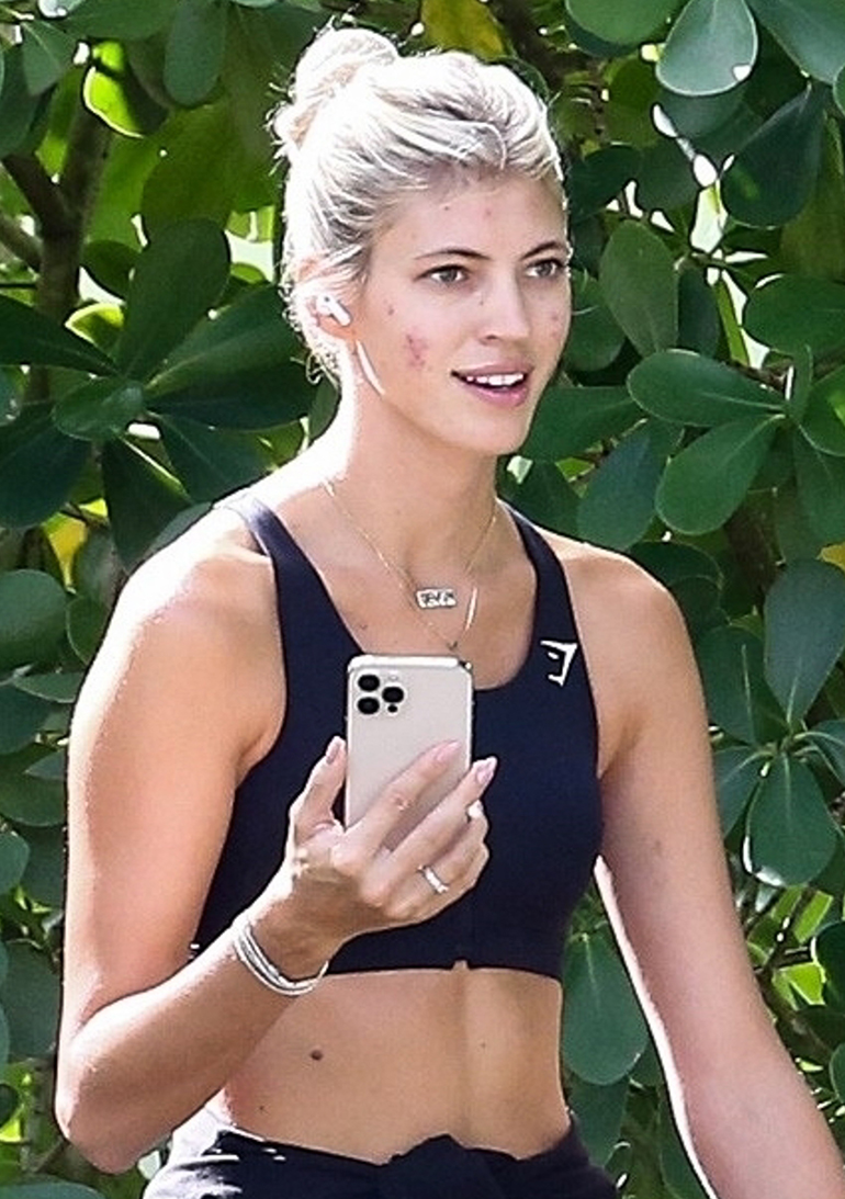 Victoria's Secret -supermalli Devon Windsor kärsii iho-ongelmista