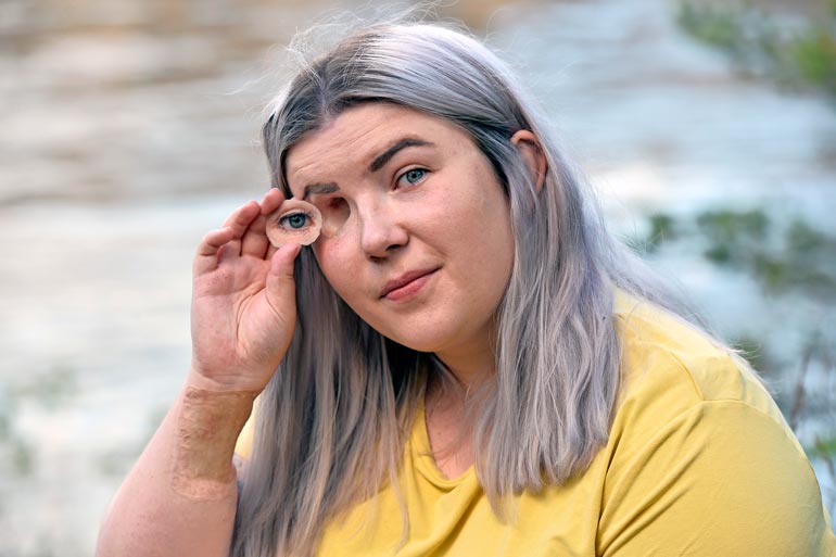 Linnealle on teetetty silmäproteesi, mutta se ei ole mieleinen. – Proteesi on niin luonnoton, Linnea toteaa.