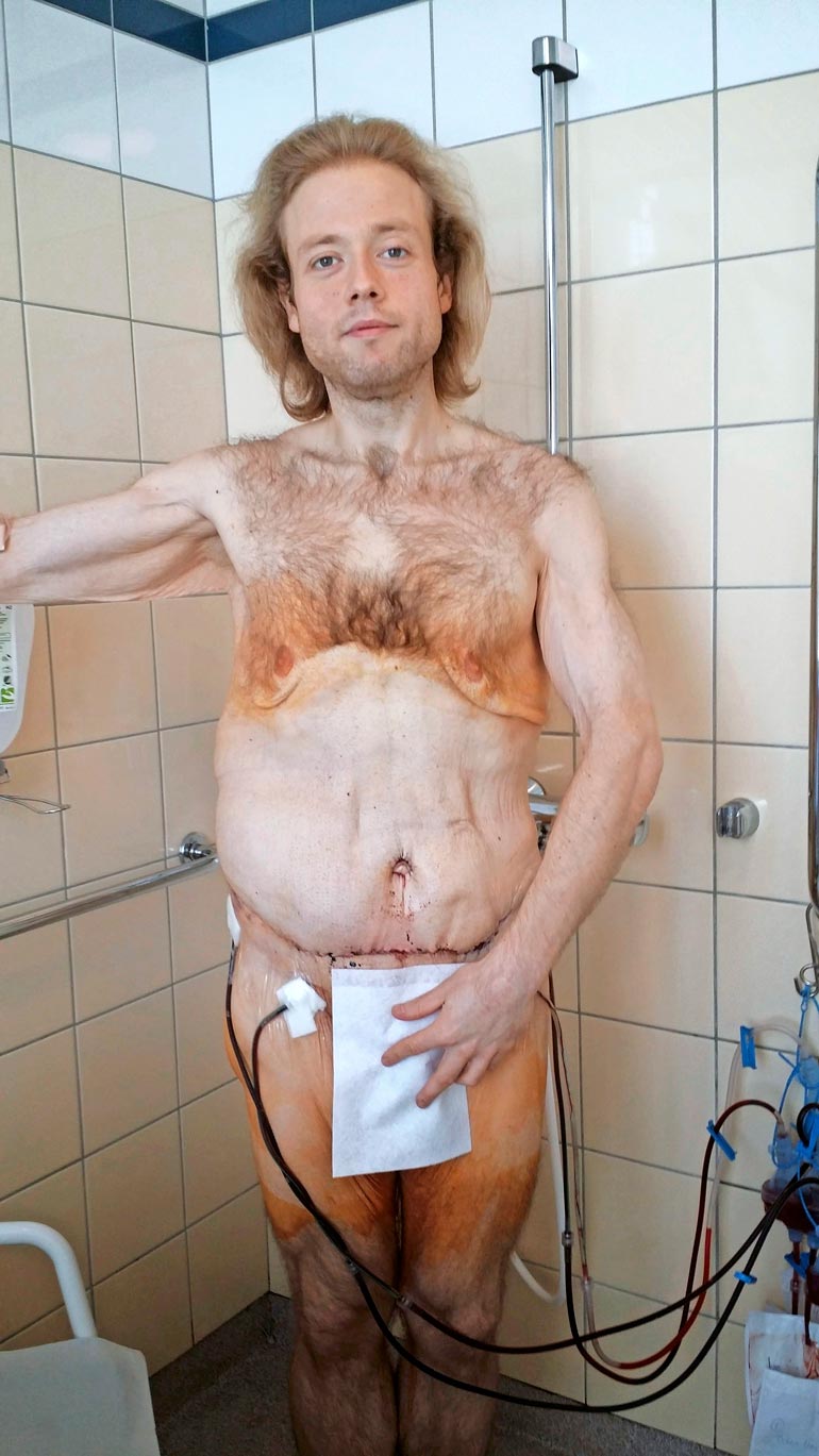 Tony on käynyt läpi kaikkiaan seitsemän leikkausta, jossa hänen löystynyttä ihoaan on kiristetty.