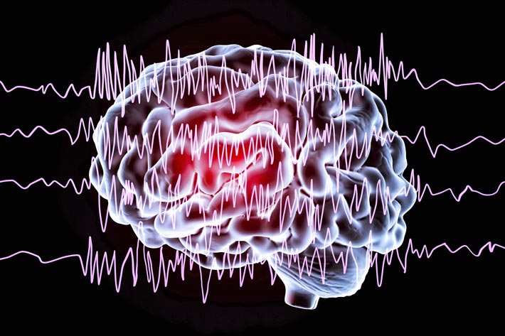 Epilepsia