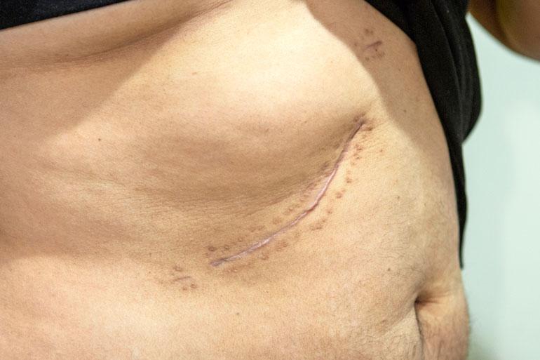 Karamilta jouduttiin avaamaan melkein koko vatsa valtavan sappikiven takia. Siitä muistutuksena jäi valtava arpi. – 30 000 euron arvoinen arpi, Karam vitsailee.