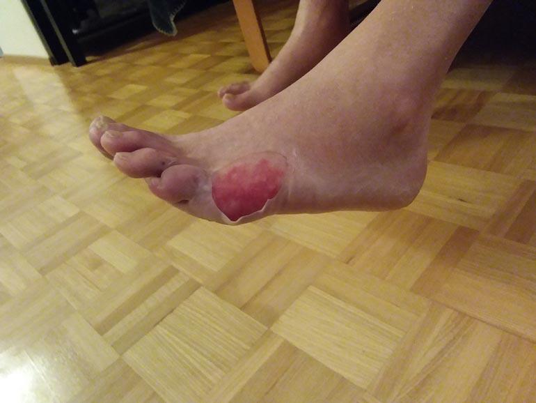 Tulikuuma vesi teki pahaa jälkeä Jarin jalansyrjään. – Diabeteksen takia jalassani ei ole tuntoa, joten en huomannut polttavaa vettä.