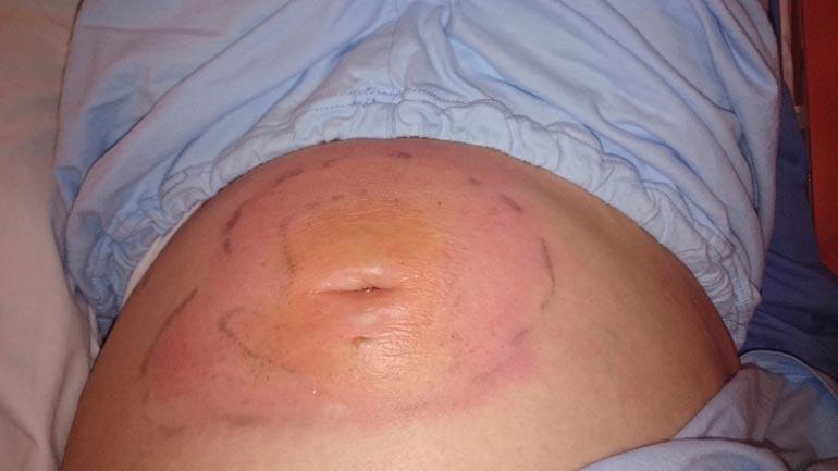 Kirurgit olisivat halunneet leikata Sinin napaseudun, mutta hematologit sanoivat, ettei tätä tyttöä leikata tai hän kuolee infektioon.