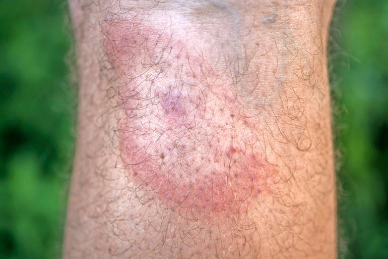 Borrelioosi