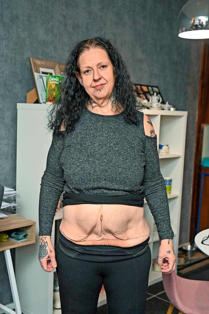 – Nyt vatsaa kestää jo katsoa, kun haavat ovat parantuneet. Ylimääräistä ihoa on vielä jäljellä, mutta uskon osaavien lääkäreiden tekevän parhaansa.